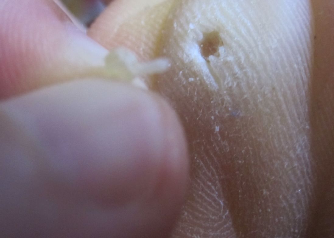 魚の目 ウオノメ にイボコロリ絆創膏を貼ったら約１週間で芯が取れ 周囲の硬い角質 皮膚も剥がれた 写真付きで効果を紹介 レキオ日記