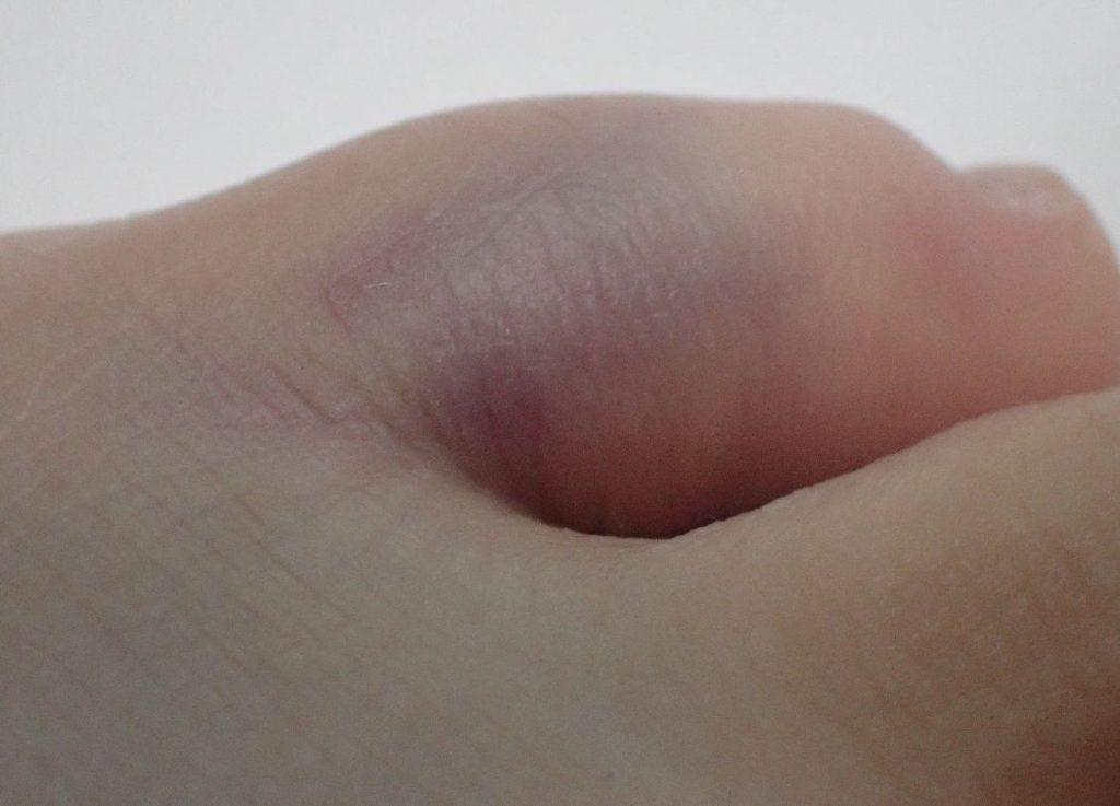 タンスの角にぶつけた足の小指が紫色に腫れて痛くなった