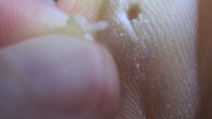 魚の目（ウオノメ）の芯を指で抜き取る衝撃の瞬間を撮影した写真
